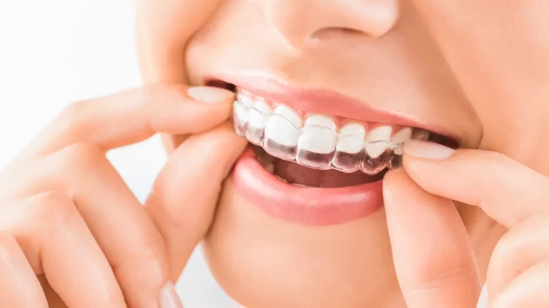 Invisalign Warszawa cena