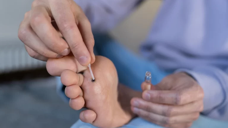 Usuwanie kurzajek w Warszawie