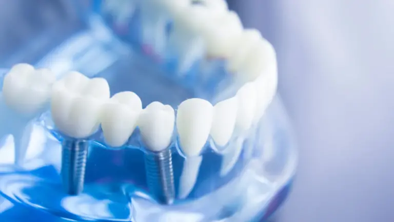 Implanty zębowe Warszawa
