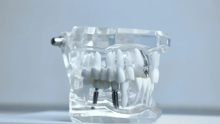 Kiedy implant po wyrwaniu zęba?