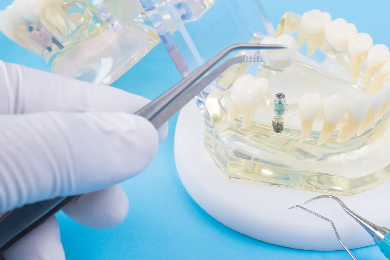 Implanty Warszawa gdzie najlepiej?